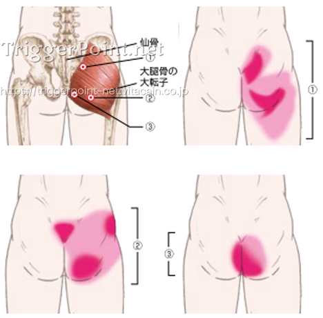 大臀筋 腰背部 好発部位について Trigger Point Net トリガーポイント ネット 医療関係者向け情報