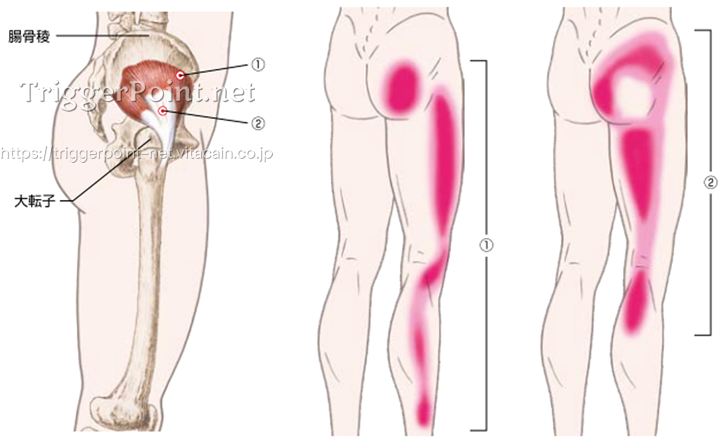 小臀筋 腰背部 好発部位について Trigger Point Net トリガーポイント ネット 医療関係者向け情報