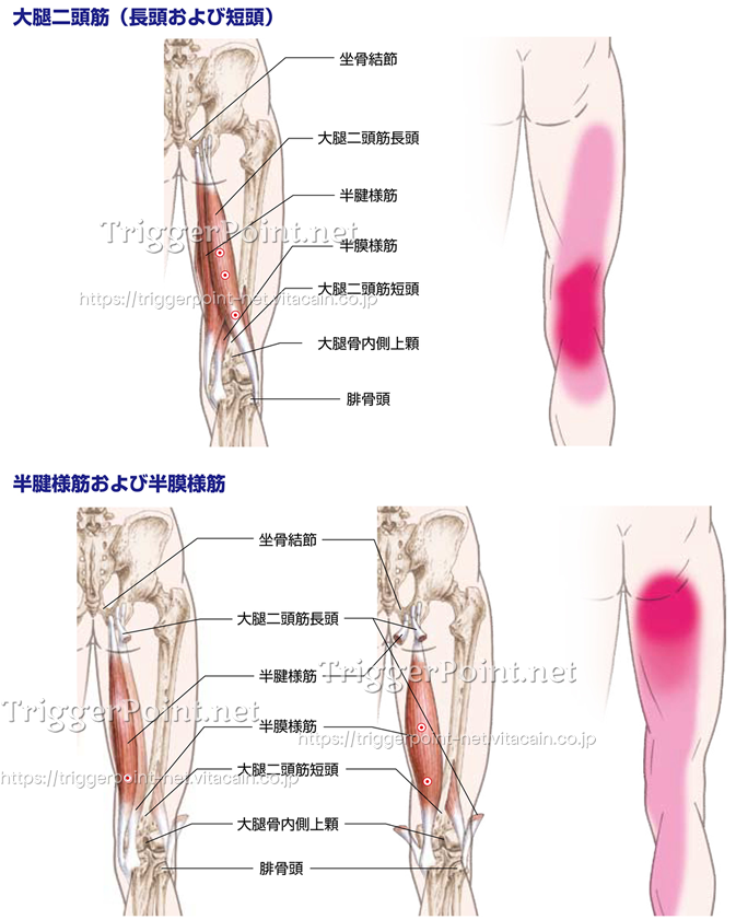 ハムストリングス 大腿二頭筋 半膜様筋 半腱様筋 下肢 好発部位について Trigger Point Net トリガーポイント ネット 医療関係者向け情報