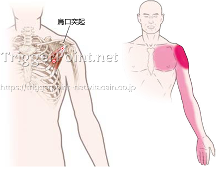 小胸筋 肩部 好発部位について Trigger Point Net トリガーポイント ネット 医療関係者向け情報