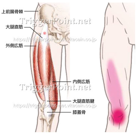 大腿四頭筋群 大腿直筋 外側広筋 内側広筋 中間広筋 下肢 好発部位について Trigger Point Net トリガーポイント ネット 医療関係者向け情報