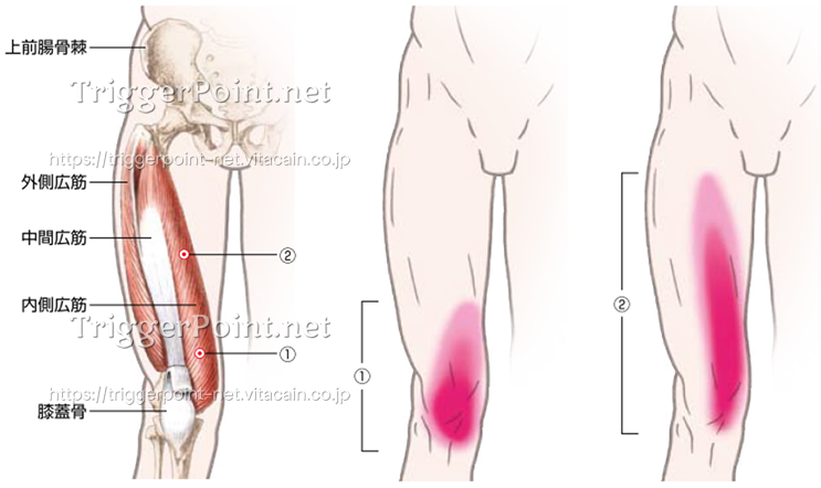 大腿四頭筋群 大腿直筋 外側広筋 内側広筋 中間広筋 下肢 好発部位について Trigger Point Net トリガーポイント ネット 医療関係者向け情報