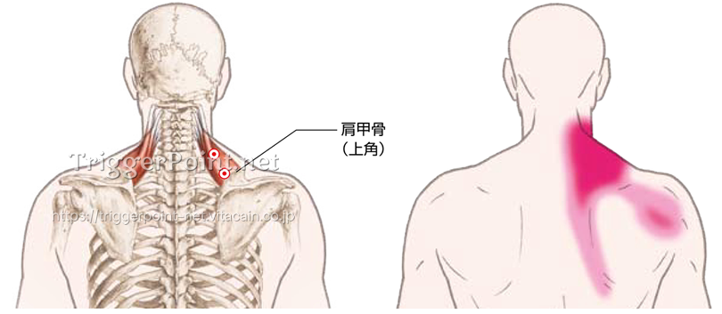 肩甲挙筋 肩部 好発部位について Trigger Point Net トリガーポイント ネット 医療関係者向け情報