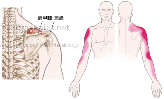 棘上筋 肩部 好発部位について Trigger Point Net トリガーポイント ネット 医療関係者向け情報