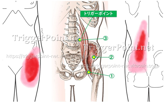 腸腰筋のトリガーポイント