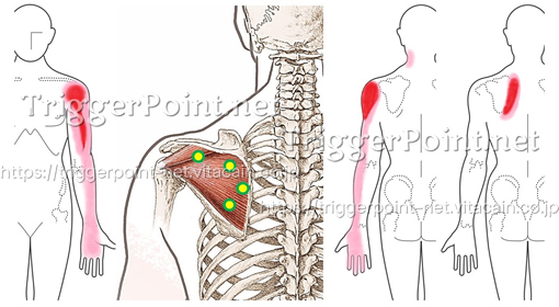 トリガーポイントの位置と関連痛領域