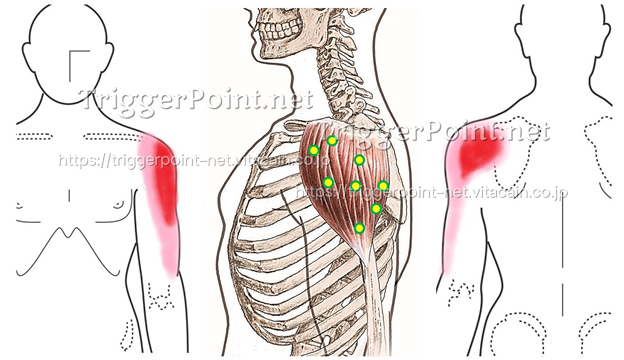 トリガーポイントの位置と関連痛領域